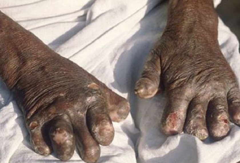 जाजरकोटमा १८ जना कुष्ठरोगी उपचाररत