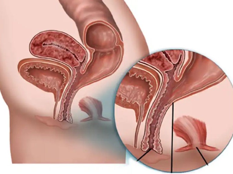 फिस्टुला रोगको उपचार निःशुल्क