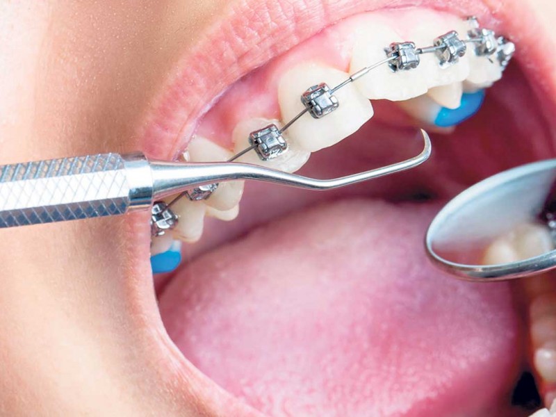 कालीकोट जिल्ला अस्पतालमा दन्त उपचार सेवा सुरू    