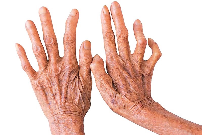 छ महिनामा ४४ कुष्ठरोगी थपिए